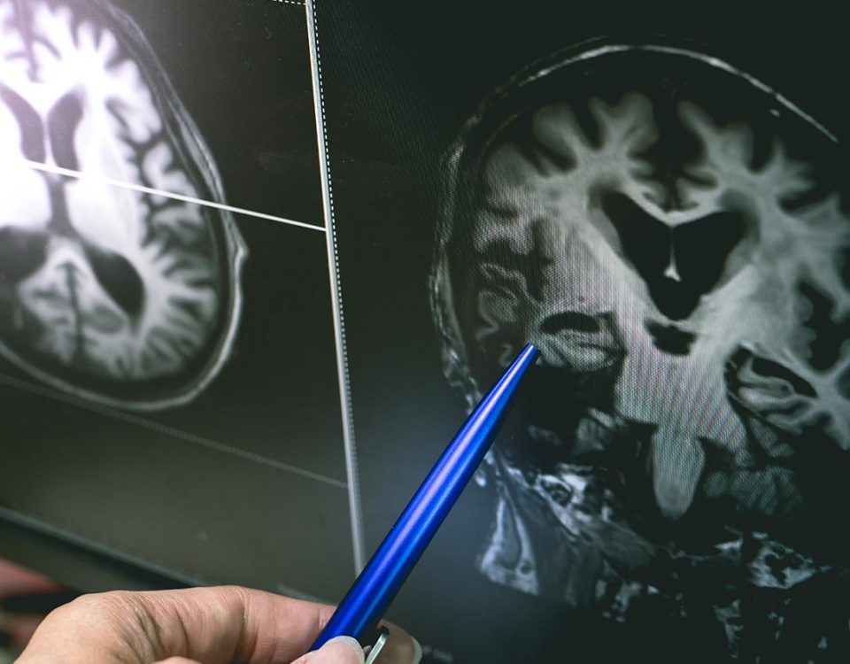 How Drug Abuse Affects White Matter in the Brain