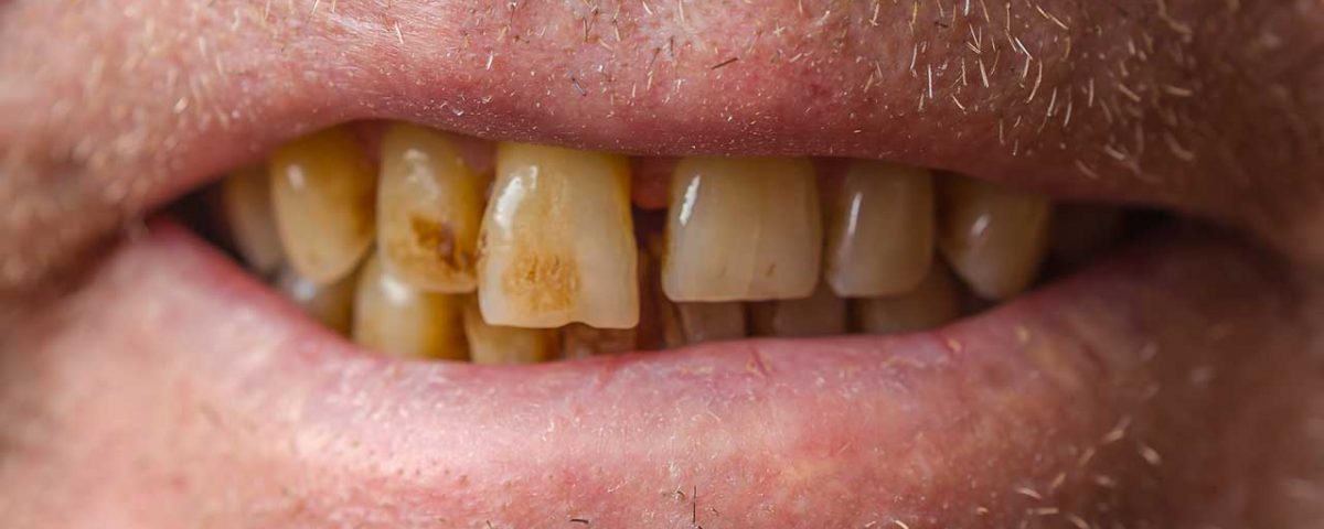 Cocaine’s Effects on Teeth