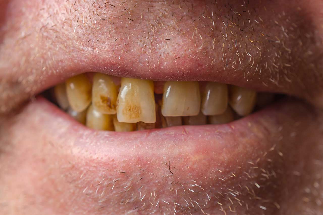 What Illegal Drugs Cause Tooth Decay? Find Out Now!