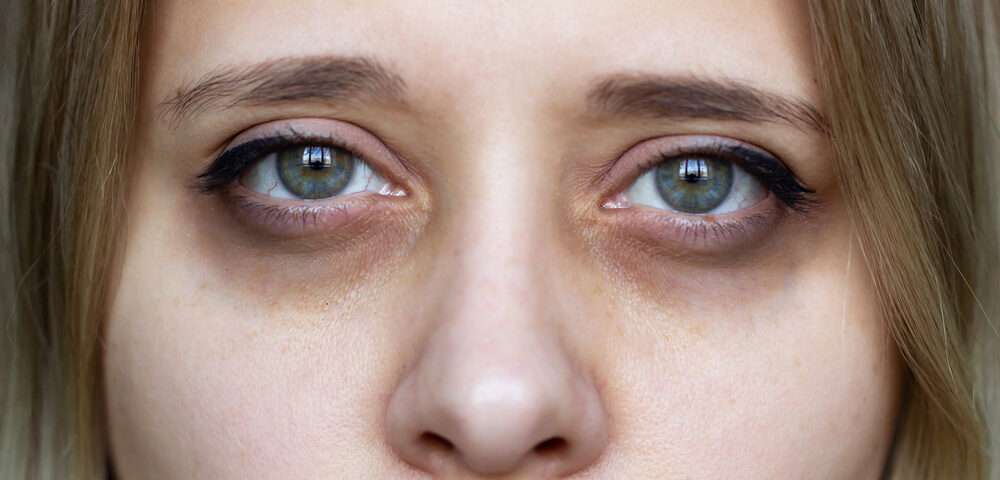 dark circles alcohol